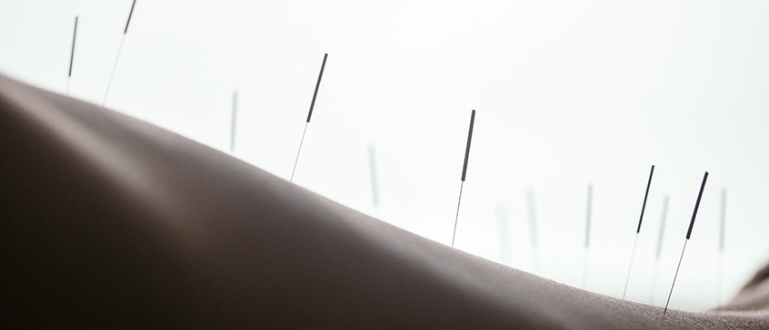A close-up, low-angle shot shows numerous thin acupuncture needles inserted into a person