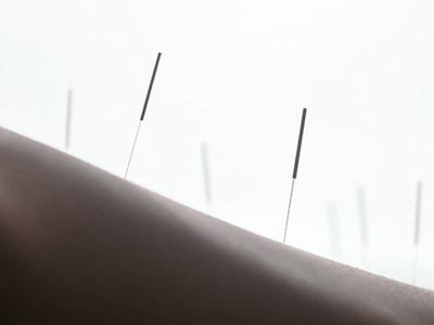 A close-up, low-angle shot shows numerous thin acupuncture needles inserted into a person